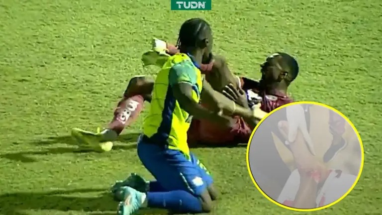 Romario da Silva sufre grave lesión en tobillo