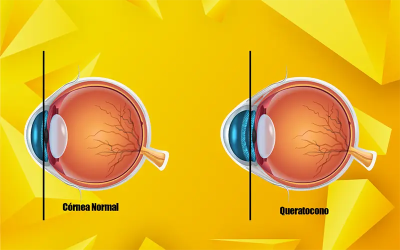 Queratocono