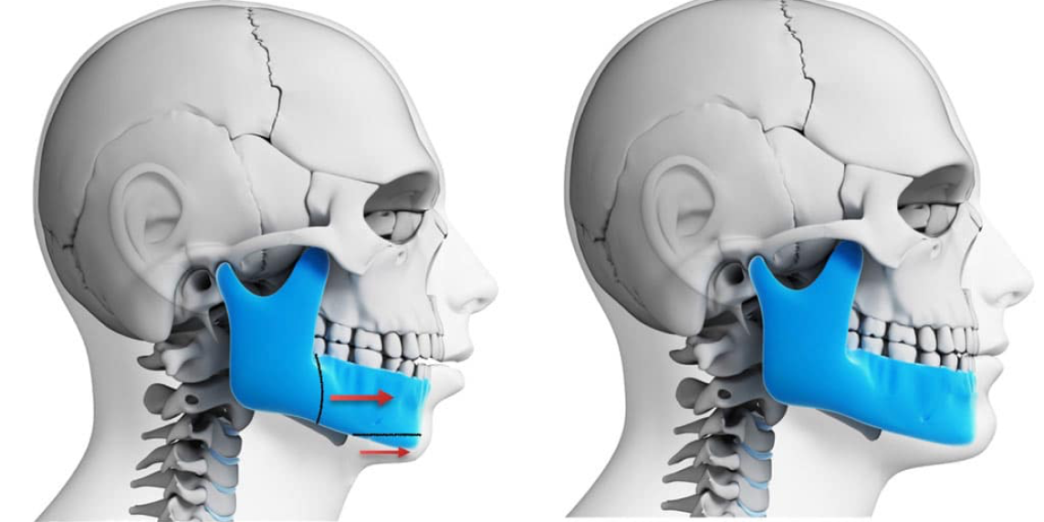 健康・医学 267 Aligner Orthodontics and Orofacial 健康・医学 267 Aligner Orthodontics and Orofacial Aligner
