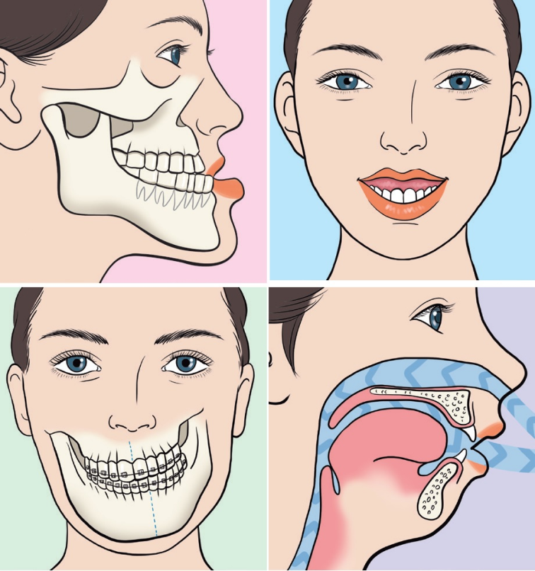 健康・医学 267 Aligner Orthodontics and Orofacial Aligner Orthodontics and Orofacial Orthopedics - Kindle