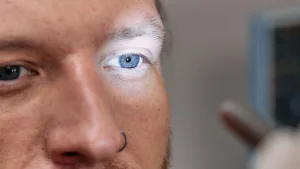 Close-up of a man's eye being examined by an ophthalmologist