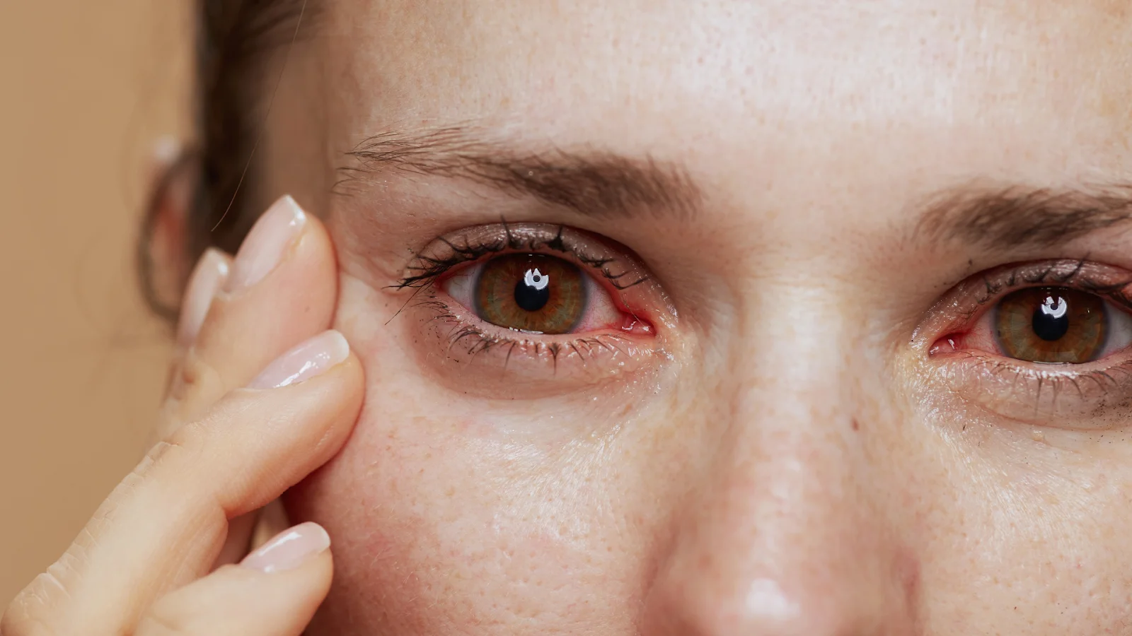 Close-up of a woman's red and irritated eyes showing signs of eye inflammation